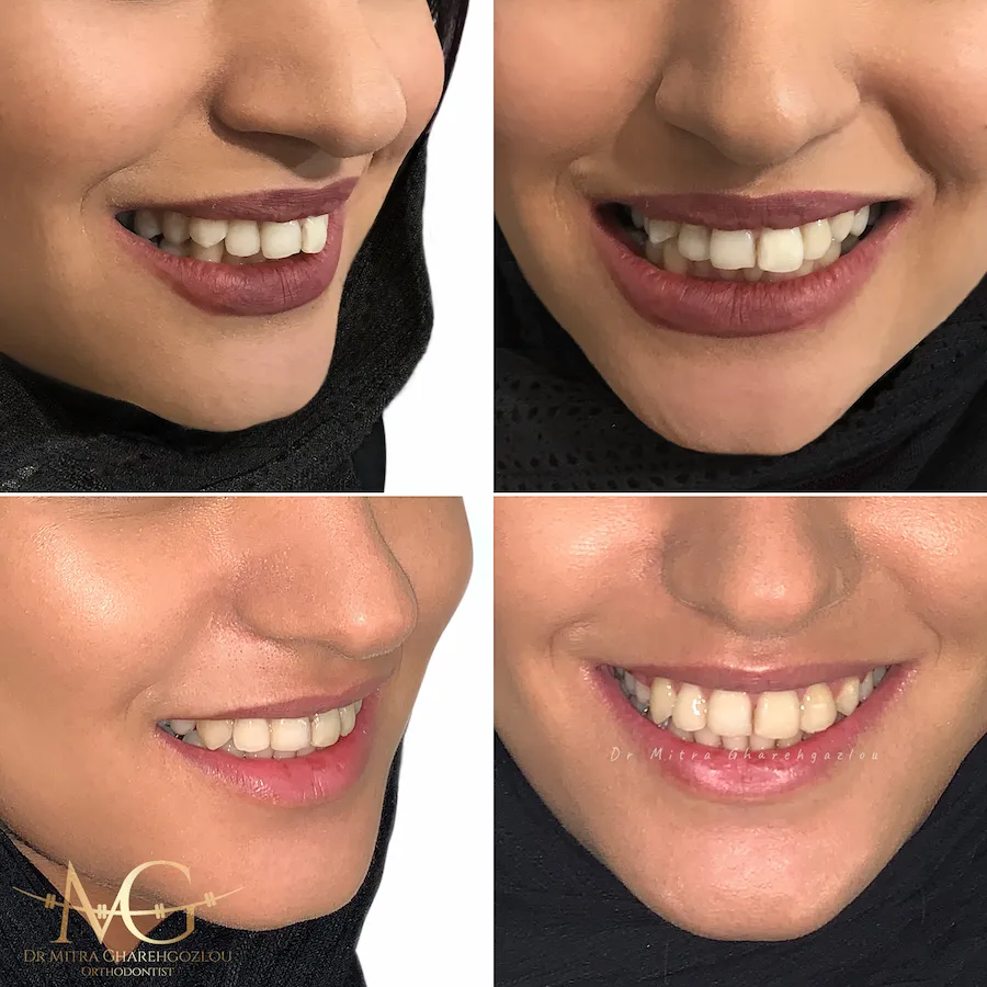 عکس ارتودنسی