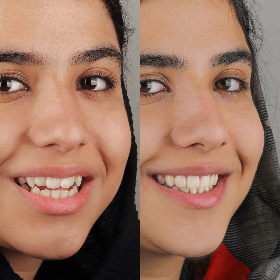 قبل و بعد ارتودنسی
