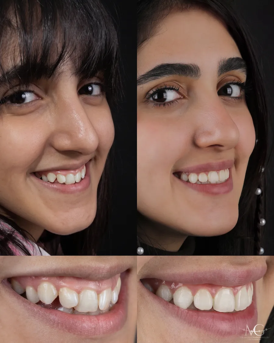 عکس قبل و بعد ارتودنسی