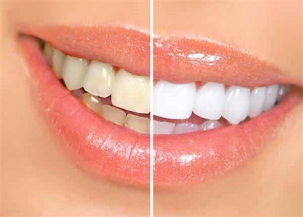 سفید کردن دندان؛ مقایسه کامل روشهای خانگی و کلینیکی، کدام بهتر است؟