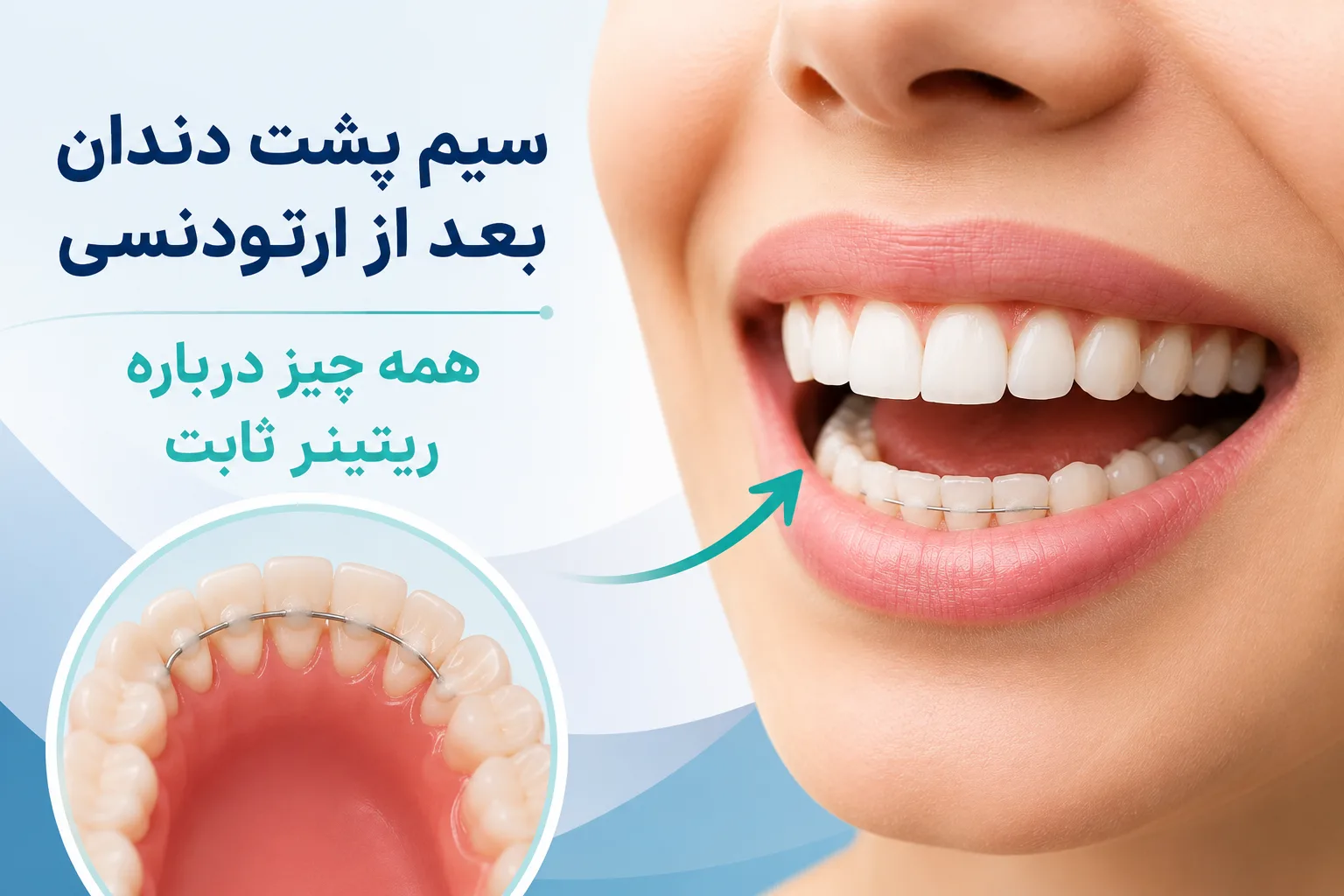 سیم پشت دندان بعد از ارتودنسی چیست و چرا اهمیت دارد؟