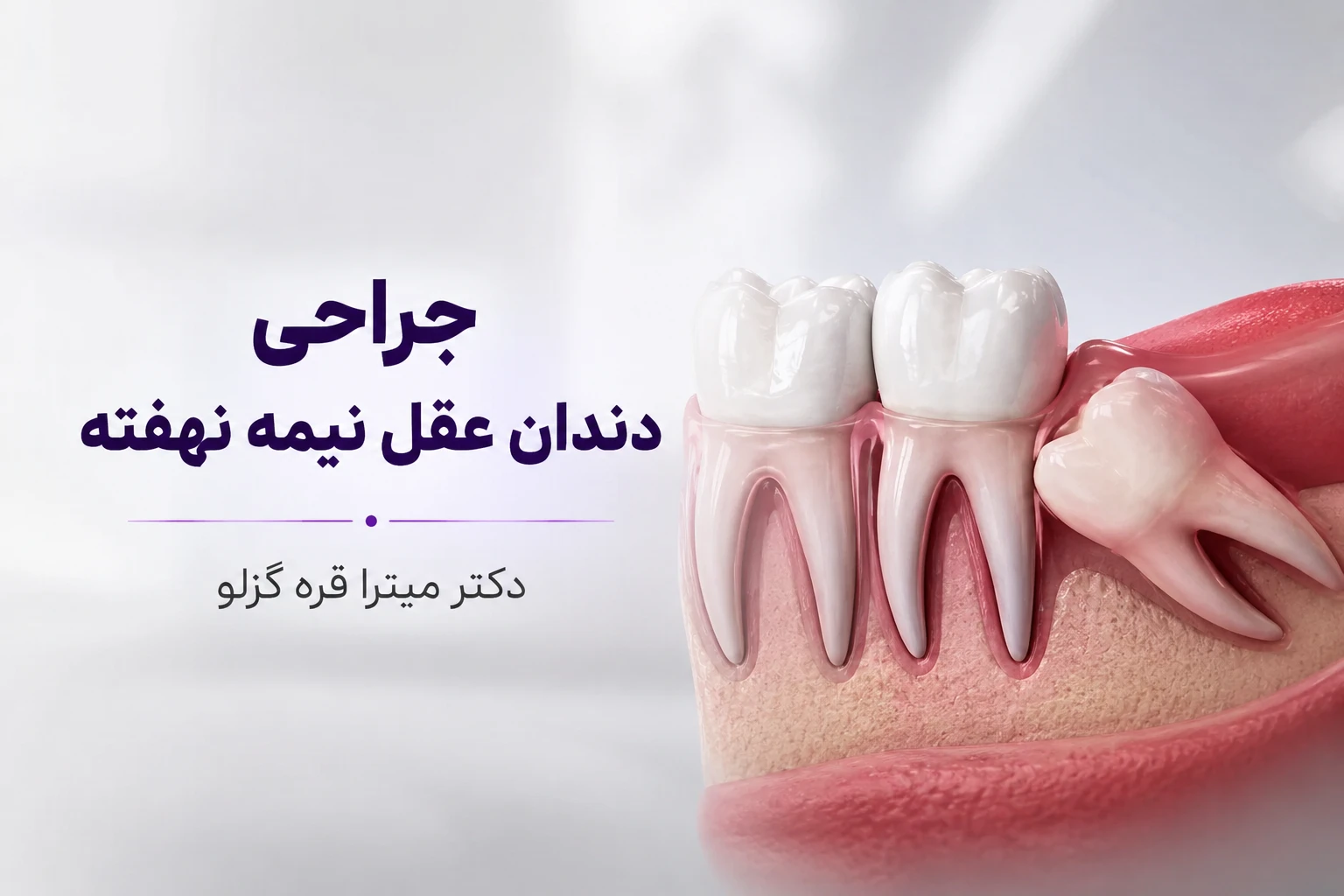 جراحی دندان عقل نیمه نهفته: راهنمای کامل از علائم تا بهبودی