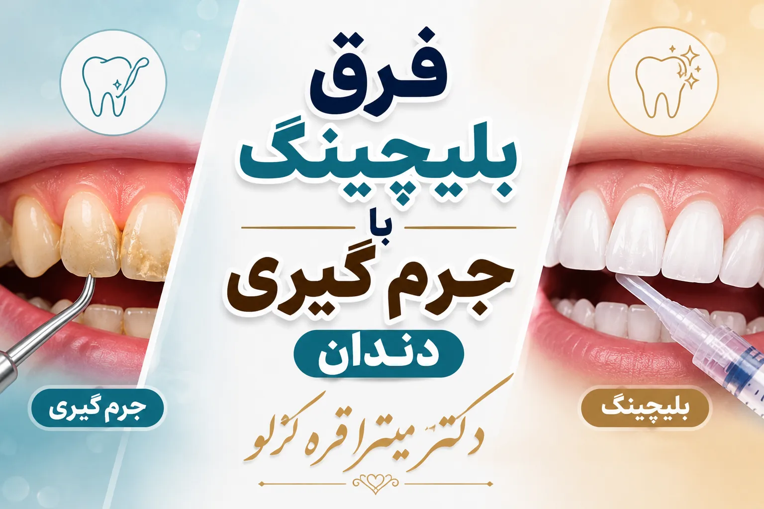 فرق بلچینگ با جرم گیری دندان در چیست؟