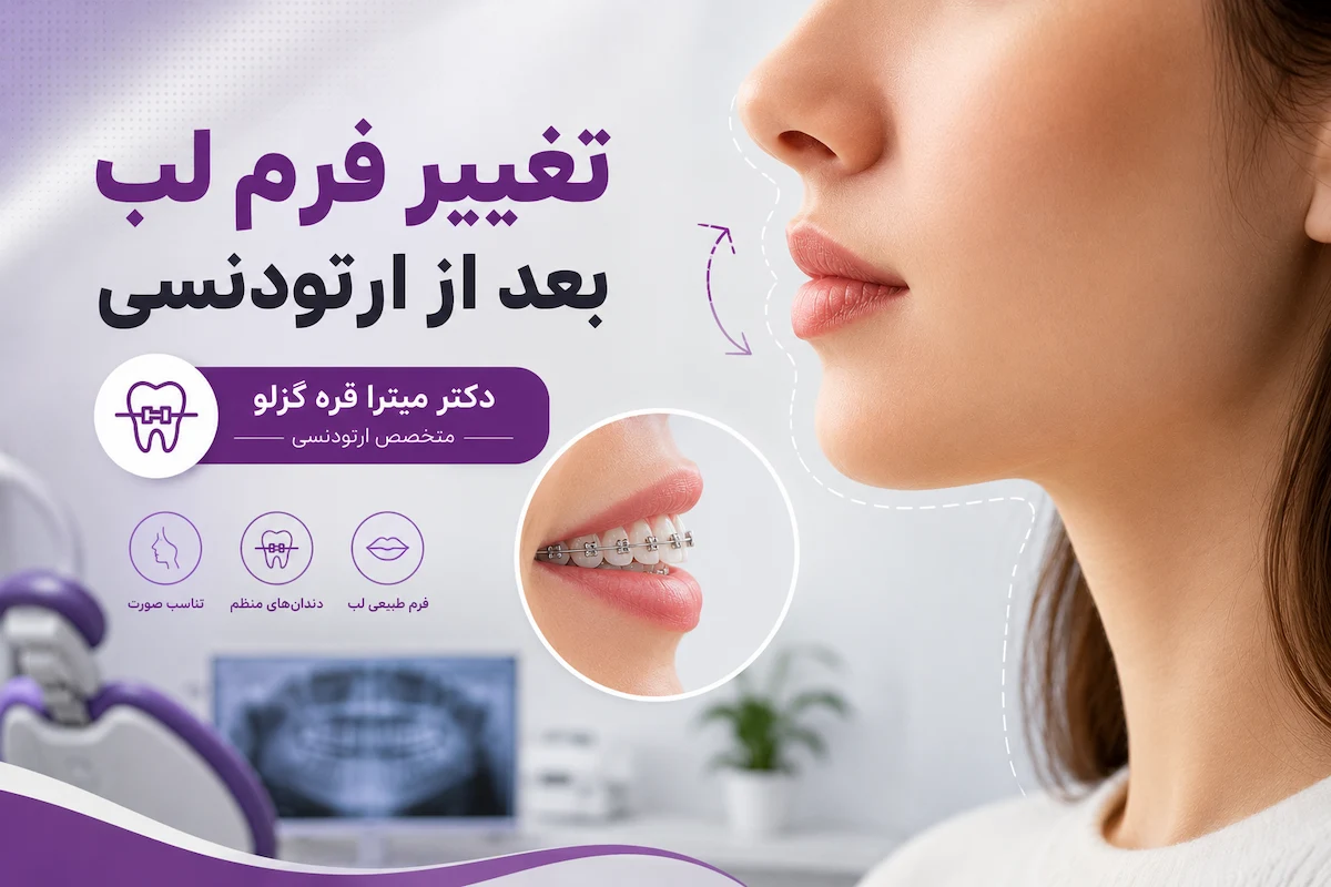تغییر فرم لب بعد از ارتودنسی؛ آیا ارتودنسی ظاهر لب‌ها را تغییر می‌دهد؟