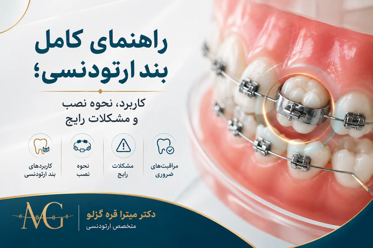 راهنمای کامل بند ارتودنسی؛ کاربرد، نحوه نصب و مشکلات رایج