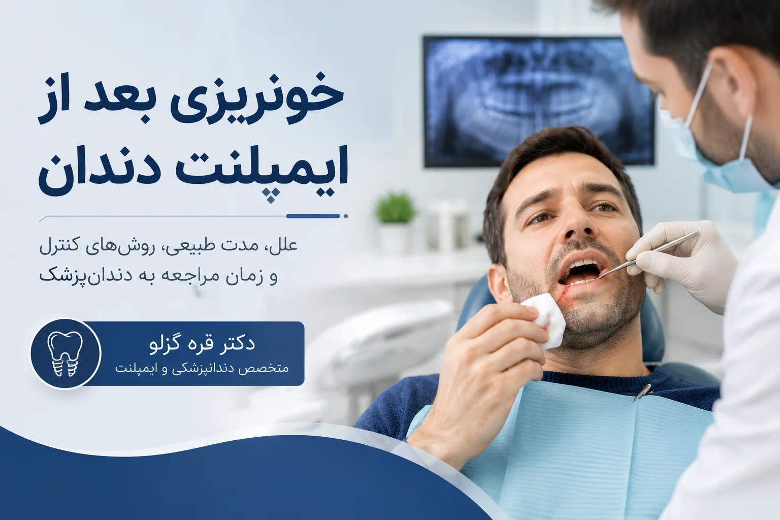 خونریزی دندان بعد از ایمپلنت؛ علت، مدت زمان و روش قطع فوری
