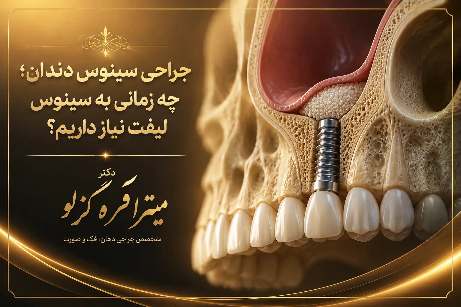 جراحی سینوس دندان چیست و چه زمانی به سینوس لیفت نیاز است؟