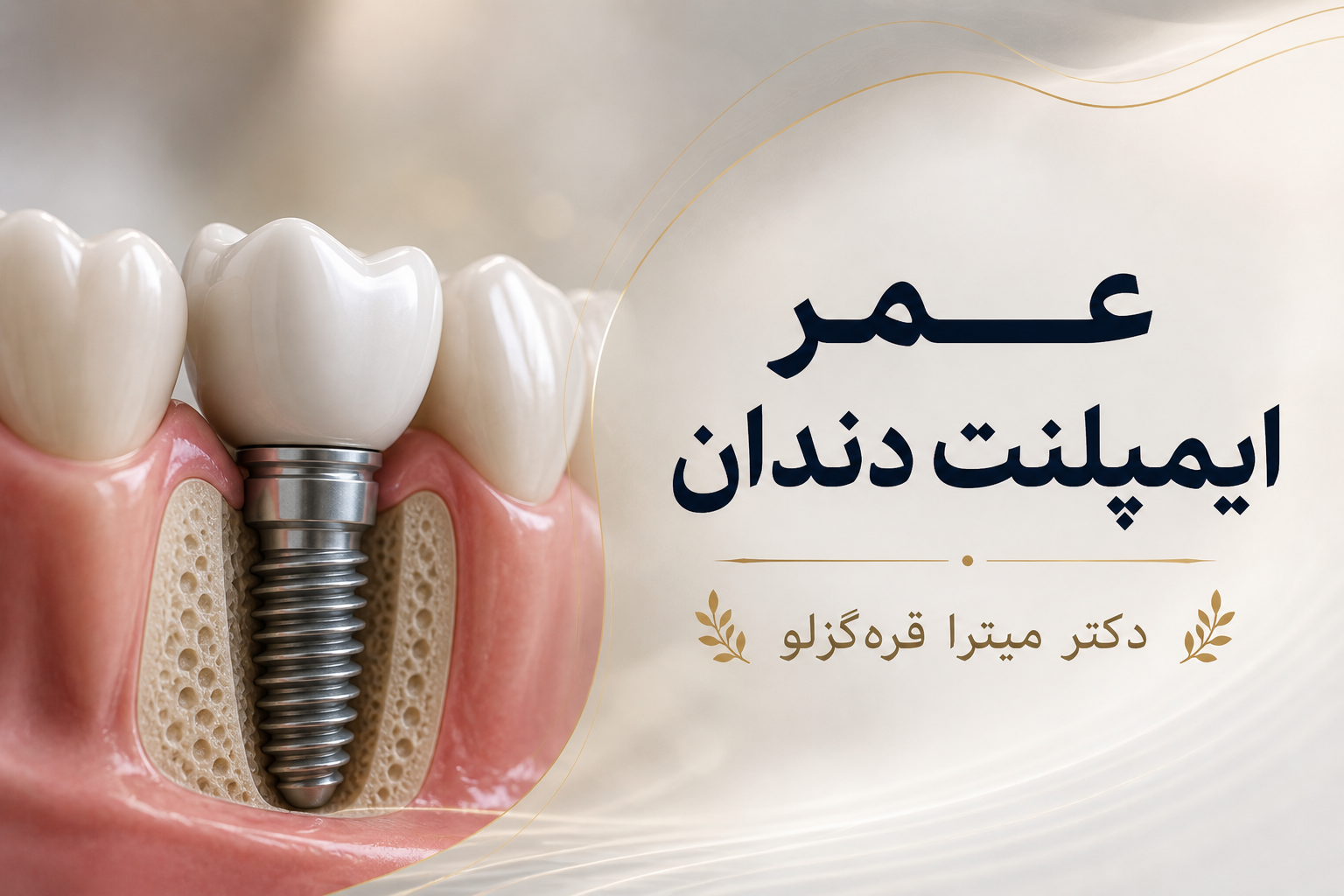 عمر ایمپلنت دندان چقدر است و به چه عواملی بستگی دارد؟