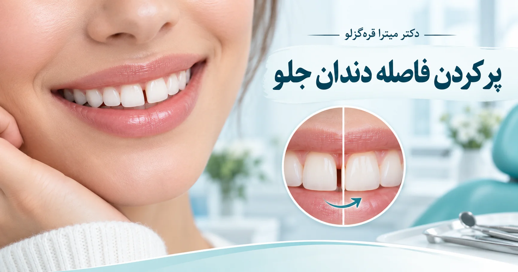 پر کردن فاصله دندان جلو؛ روشها، هزینه و انتخاب درمان