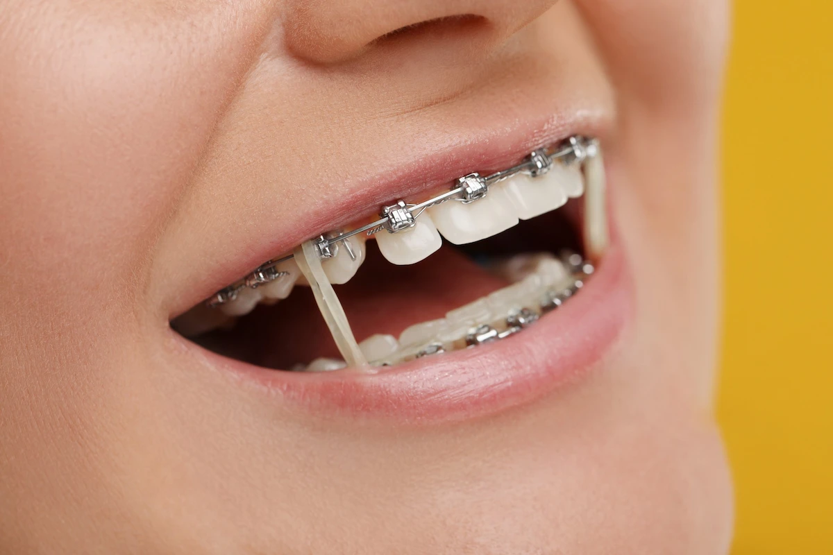 ارتودنسی ثابت فک بالا