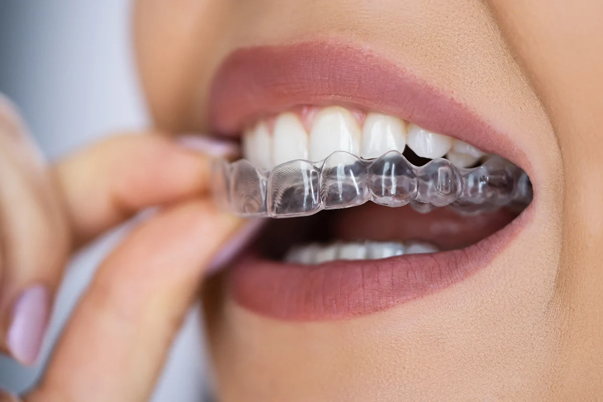 نگهدارنده بعد از ارتودنسی