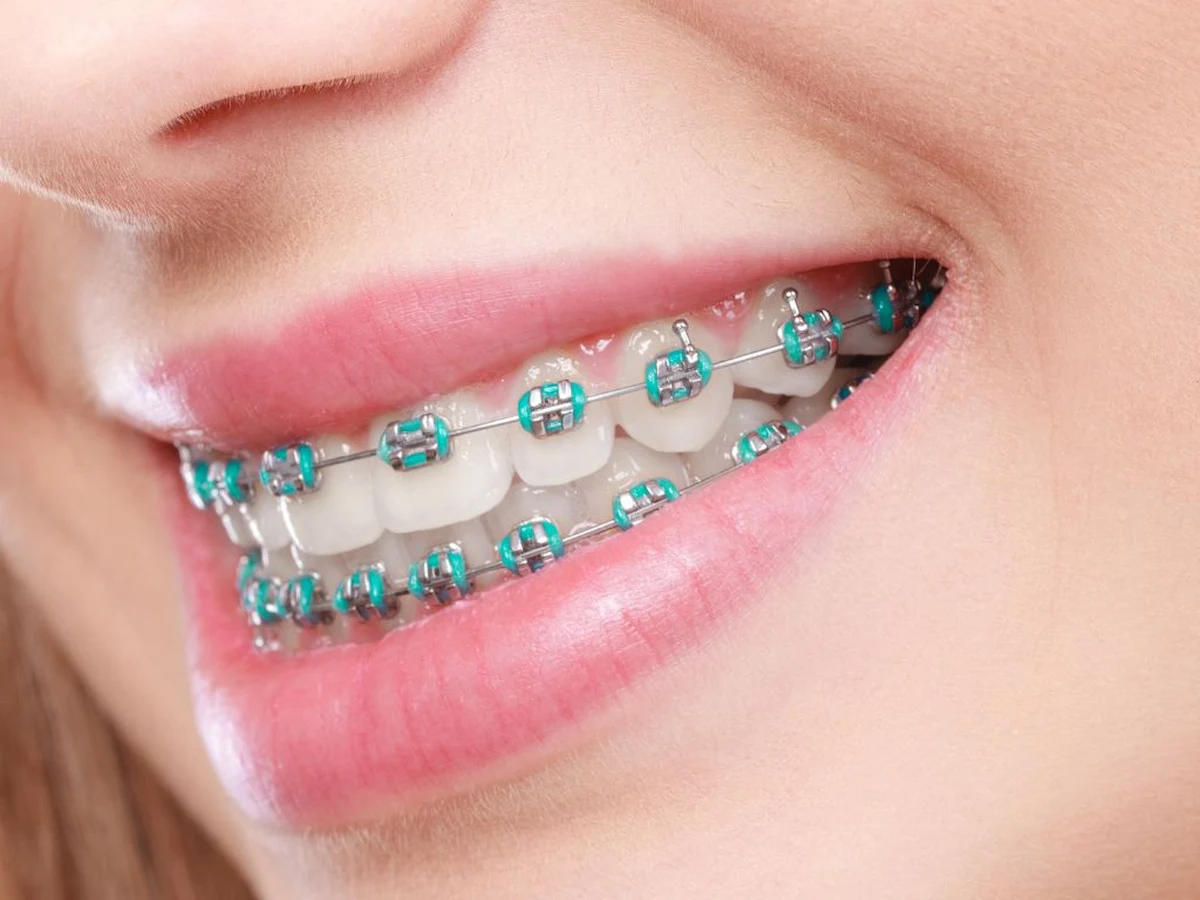 بهترین رنگ ارتودنسی
