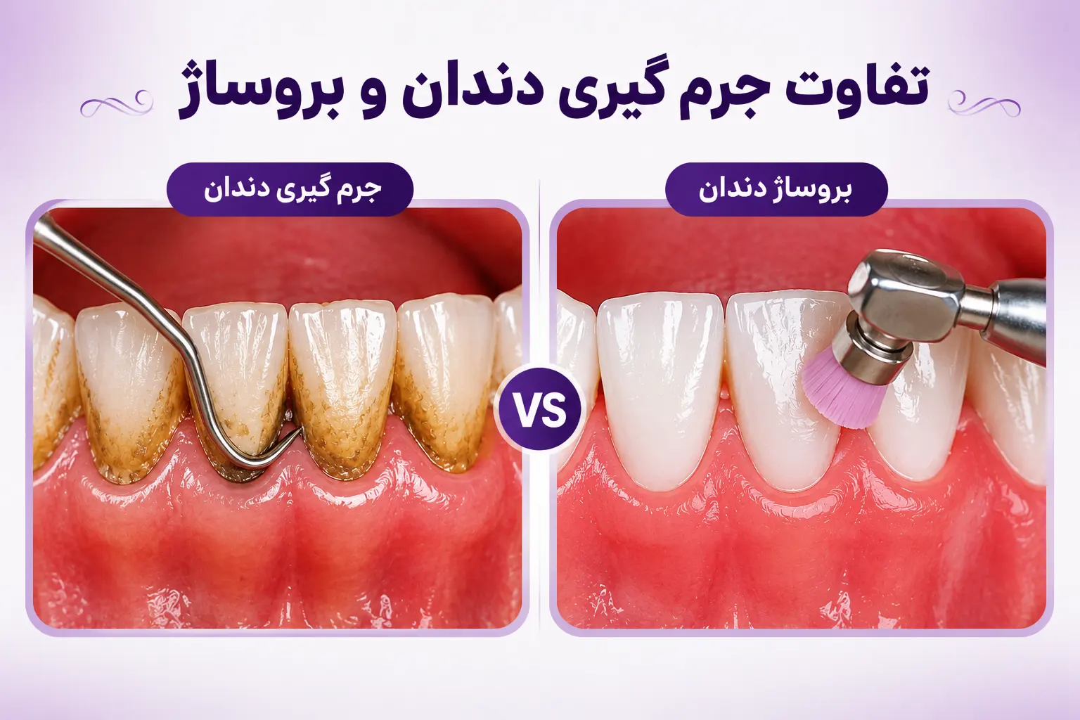 مزایای جرمگیری و بروساژ دندان