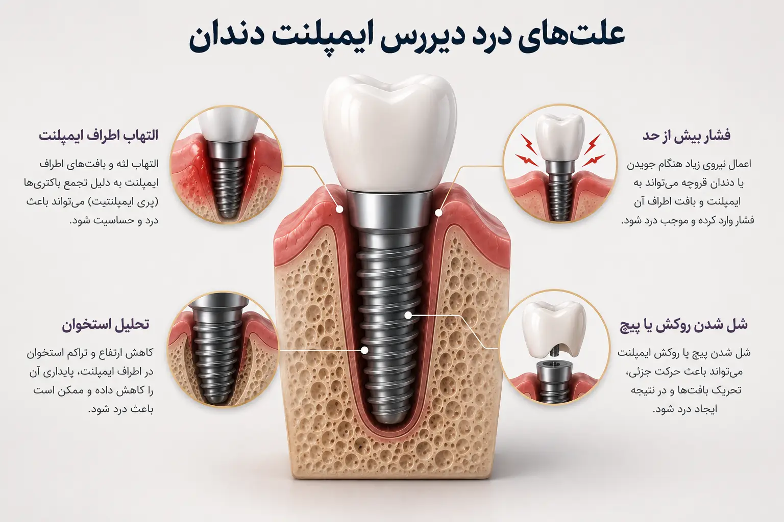 علت درد دیررس ایمپلنت دندان