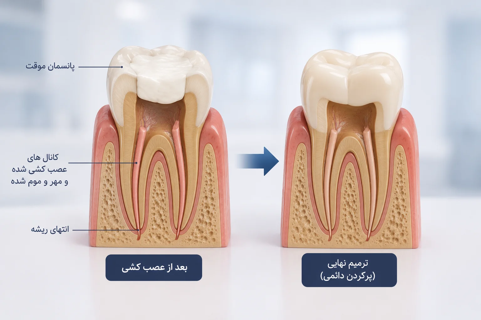 پر کردن دندان بعد از عصب کشی