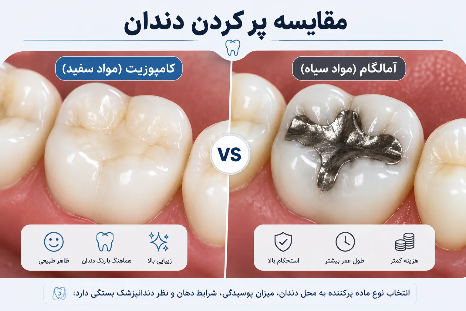 مقایسه پر کردن دندان