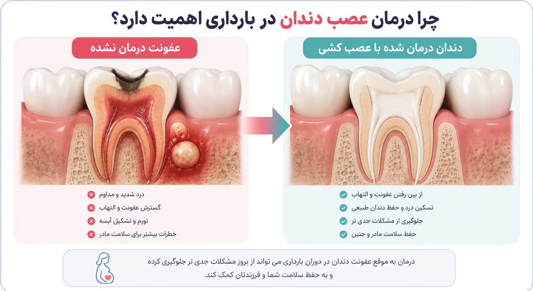 اهمیت درمان عصب کشی در بارداری