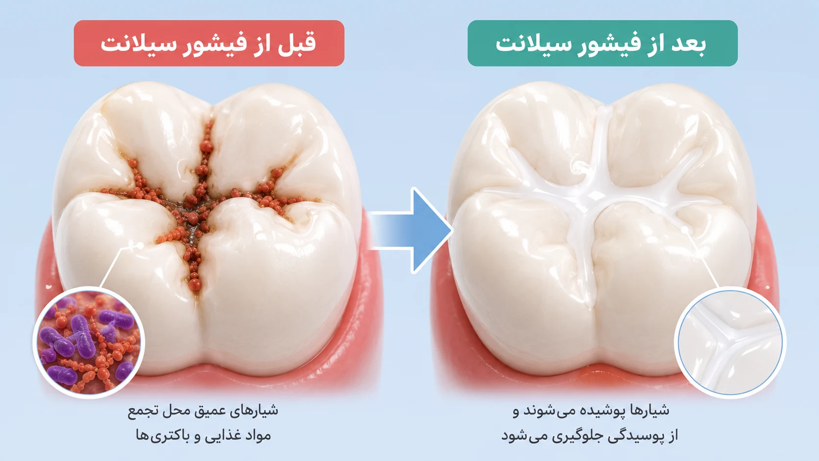 بهترین سن برای فیشور سیلانت