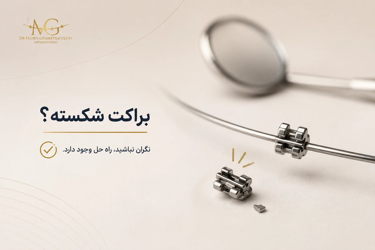 هزینه شکستن براکت ارتودنسی
