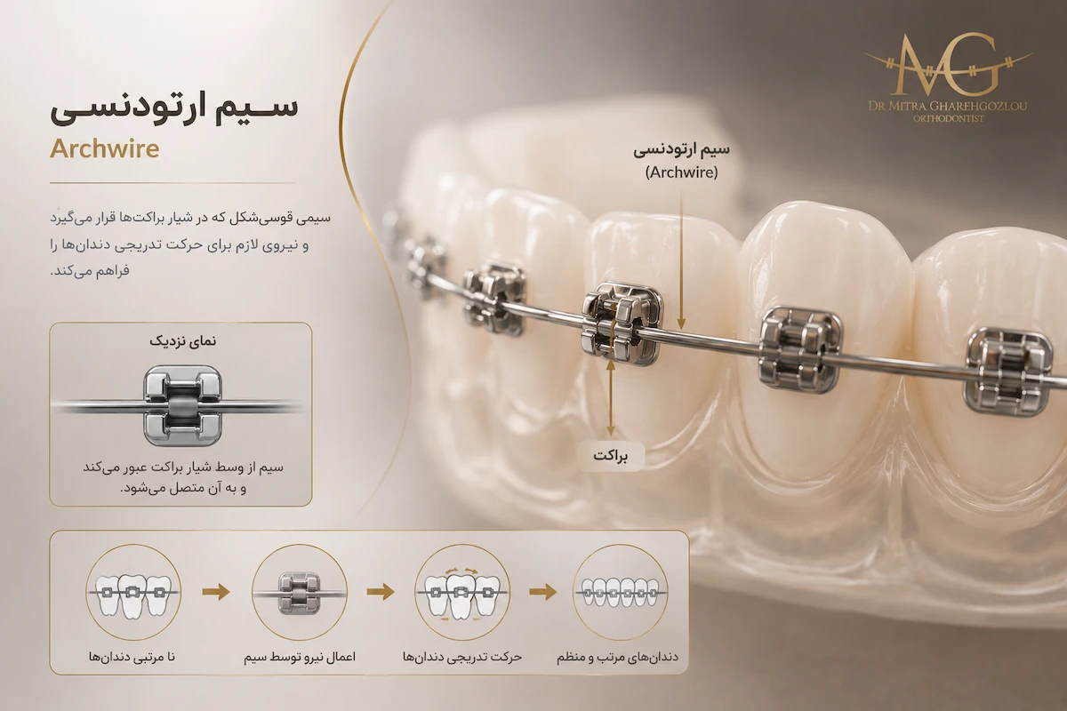 نحوه قرار گرفتن سیم ارتودنسی داخل شیار براکت