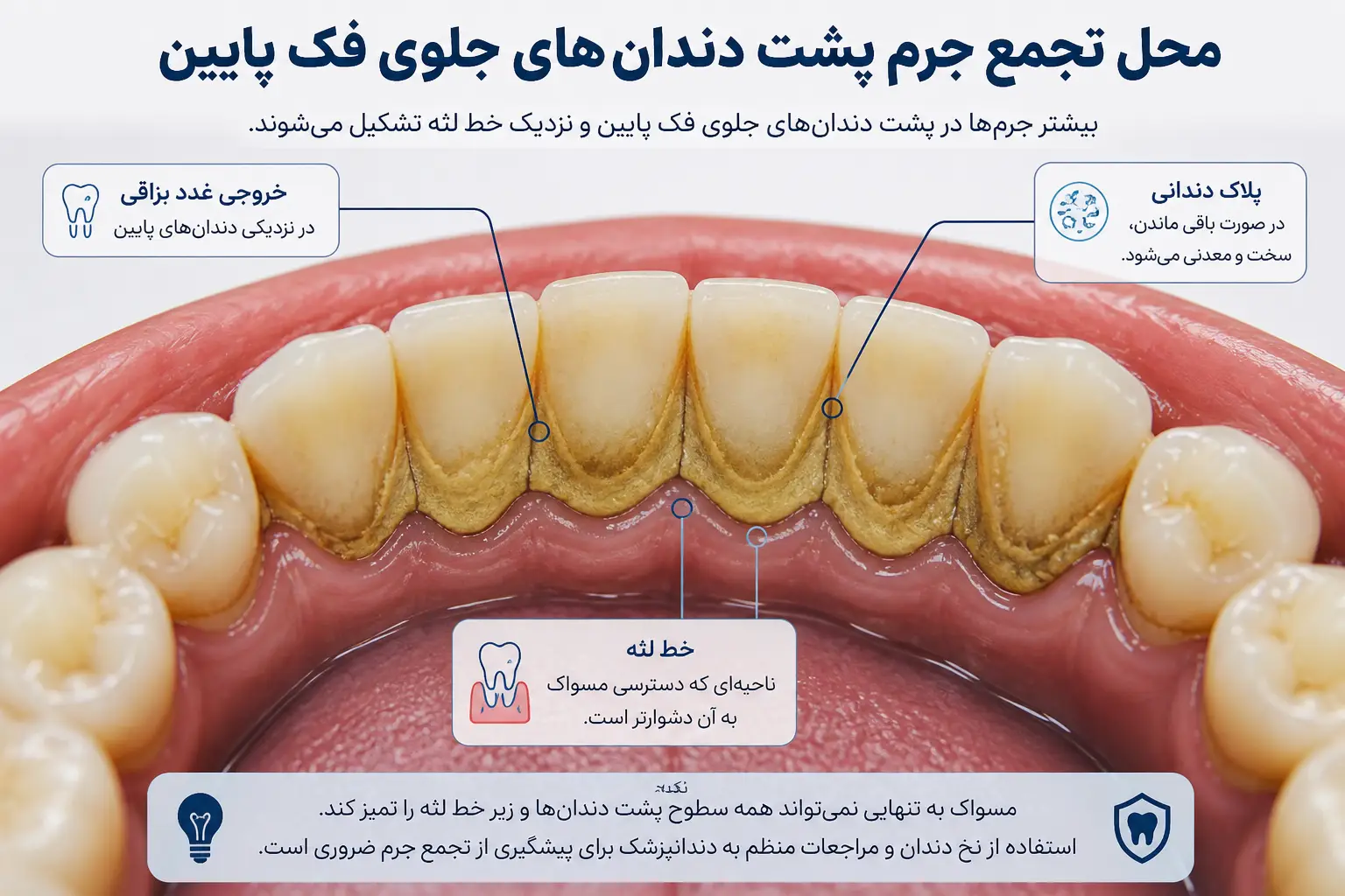 جرم پشت دندان