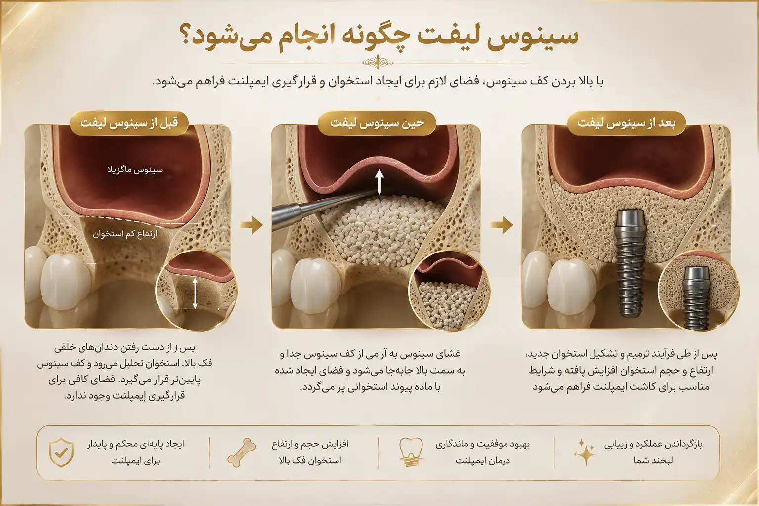 سینوس لیفت چگونه انجام می شود