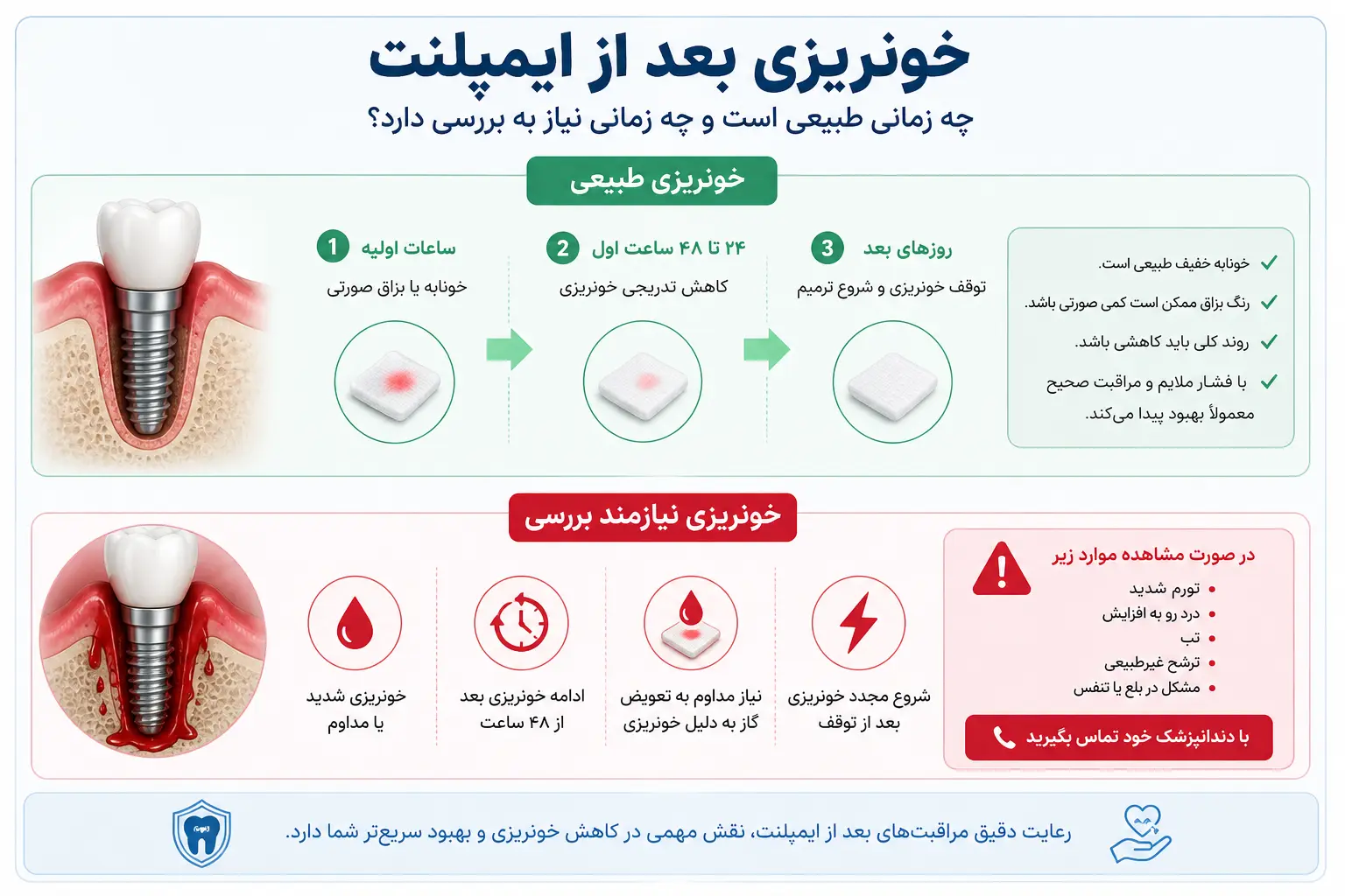 خونریزی بعد از ایمپلنت دندان طبیعی است