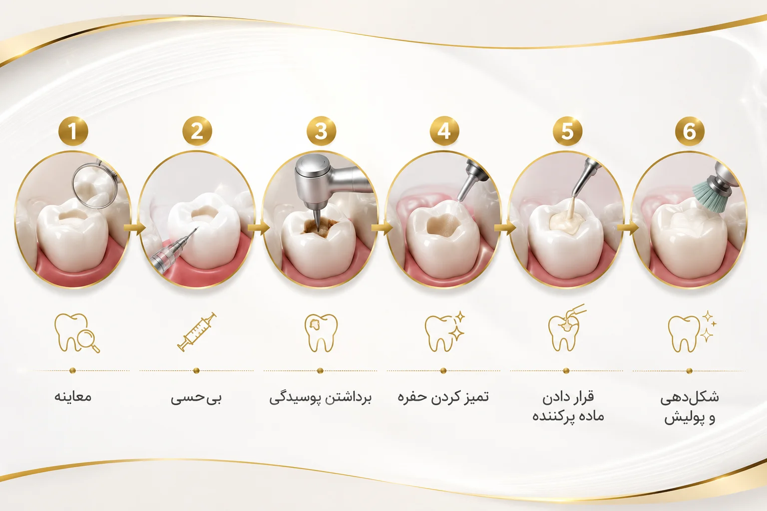 مراحل پر کردن دندان چیست