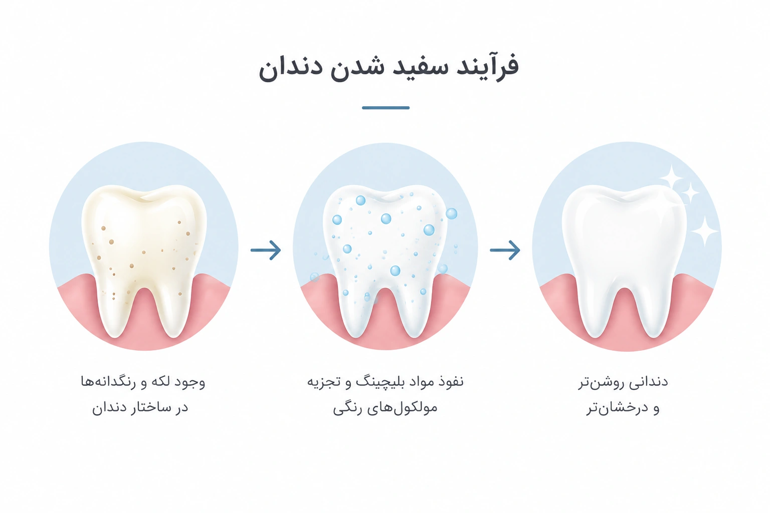 فرآیند سفید شدن دندان با بلچینگ