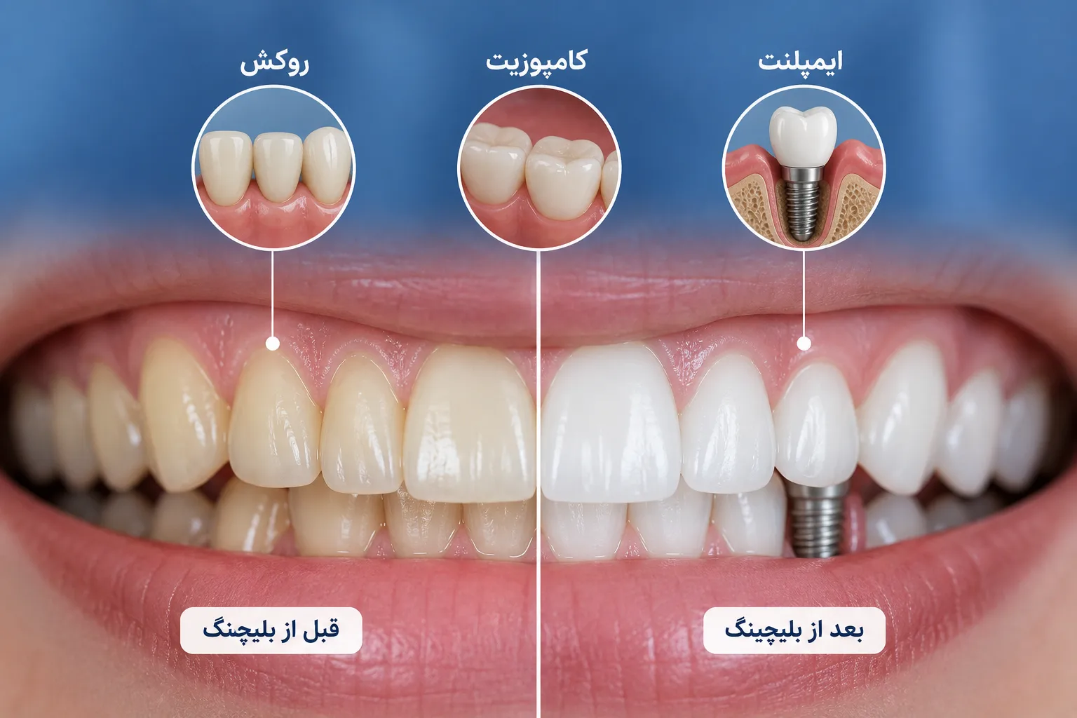 آیا روکش، کامپوزیت و ایمپلنت هم با بلیچینگ سفید میشوند؟